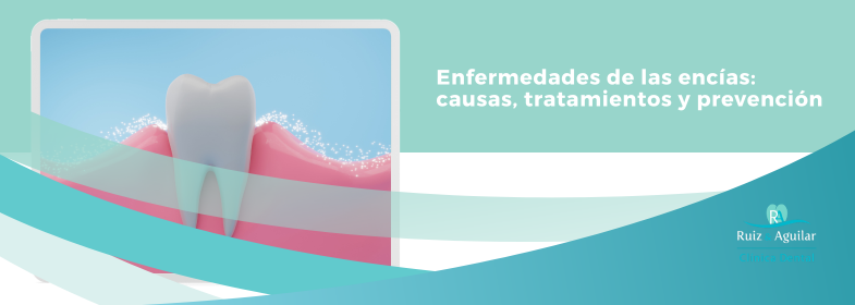 En este momento estás viendo Enfermedades de las encías: causas, tratamientos y prevención