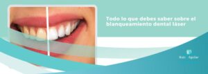 Lee más sobre el artículo Todo lo que debes saber sobre el blanqueamiento dental láser