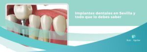 implantes dentales sevilla