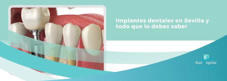 Lee más sobre el artículo Implantes dentales en Sevilla y todo que lo debes saber