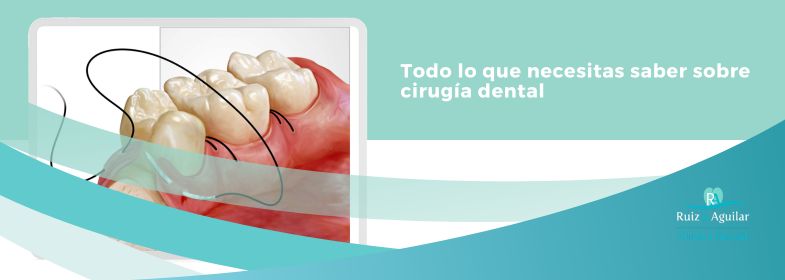 Lee más sobre el artículo Todo lo que necesitas saber sobre cirugía dental